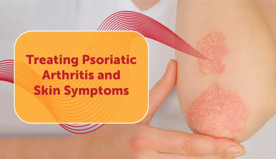 10 Early Signs and Symptoms of Plaque Psoriasis