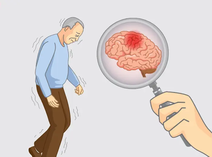 Alzheimer's Disease Treatment: Latest Options and Care Strategies