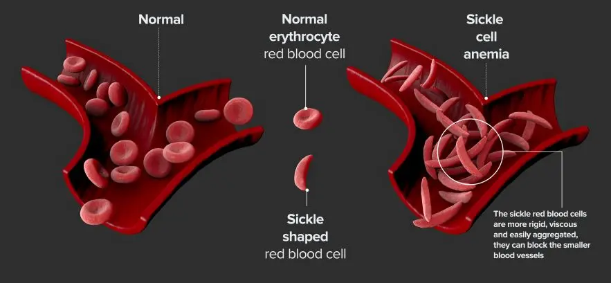 Navigating Health Insurance Options for Sickle Cell Disease Patients in the U.S.