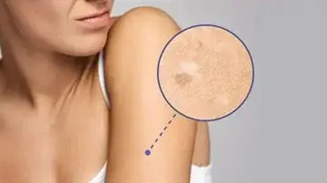 Pele sem Manchas: Melhores Tratamentos e Procedimentos Eficazes